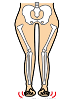 股関節Ｏ脚