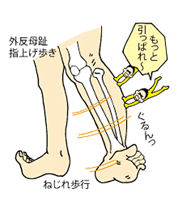 「ひざ下Ｏ脚」のメカニズム