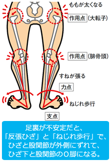 「反張ひざ」と「ねじれ歩行」でひざ下と股関節のＯ脚になる