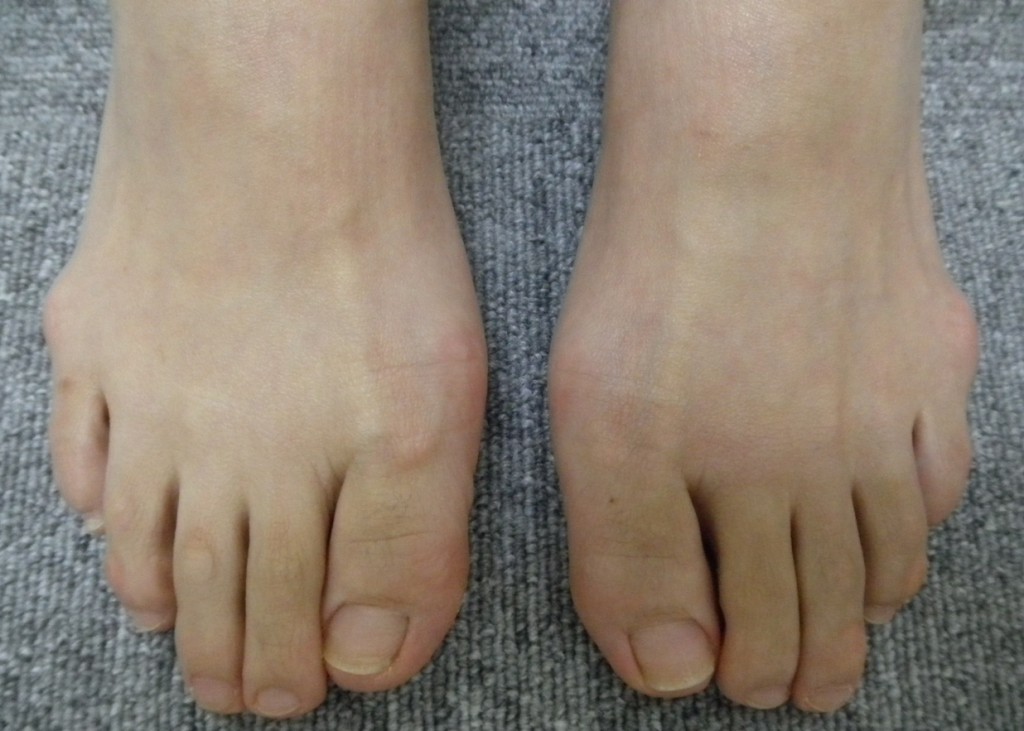 【診療レポート】20代女性 足にできるタコで分かる体の不調とは？